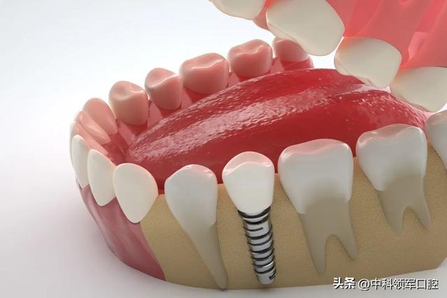 种植牙中的即刻种植、即刻负重是什么意思？