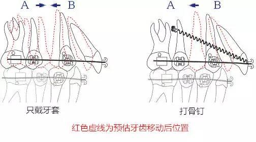 牙齿矫正，什么情况下需要打骨钉？