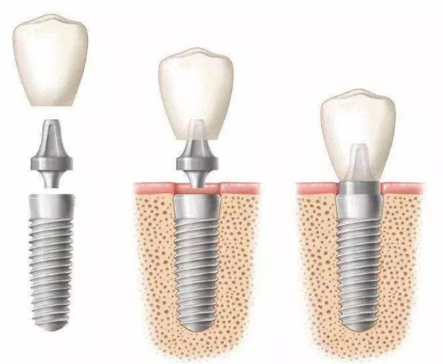 做种植牙要多少钱