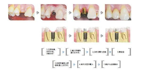 今天就告诉你，种植牙的详细的6大过程