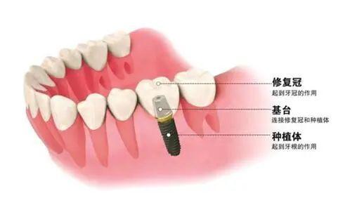 种植牙真的能用一辈子吗？最客观严谨的回答是……