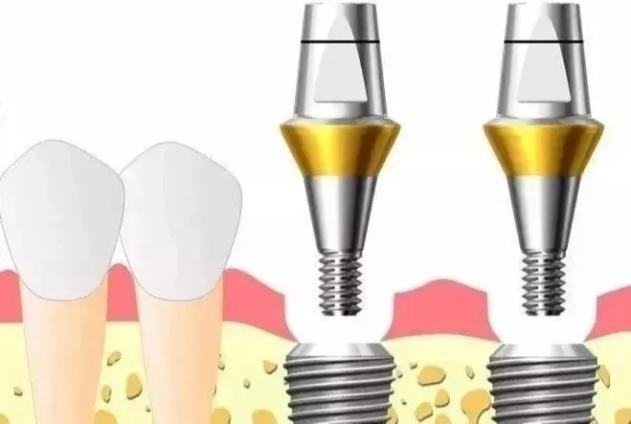 「牙齿那些事儿」No.120丨几千和几万元的种植牙，有什么区别？