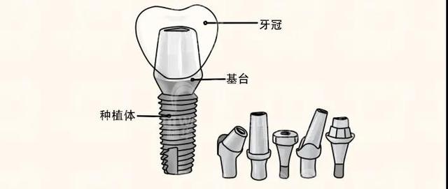 医生说骨头条件差，种牙加骨粉、骨膜，骨粉是什么东西吗？