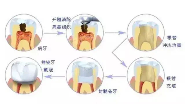 根管治疗后要我带牙冠？医生你没骗我吧？