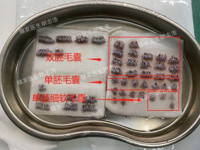 揭秘植发手术的全过程