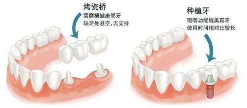 种植牙与义齿的主要区别是什么