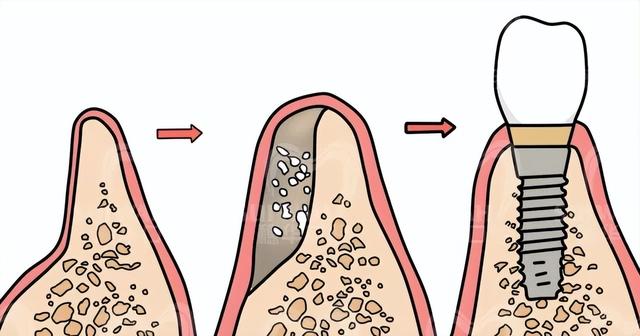 种植牙竟然还要填几千块的骨粉？这怕不又是个“收费套路”吧