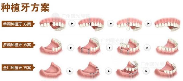 种植牙的简介