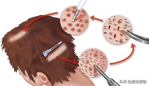 微针植发是提取毛囊吗？