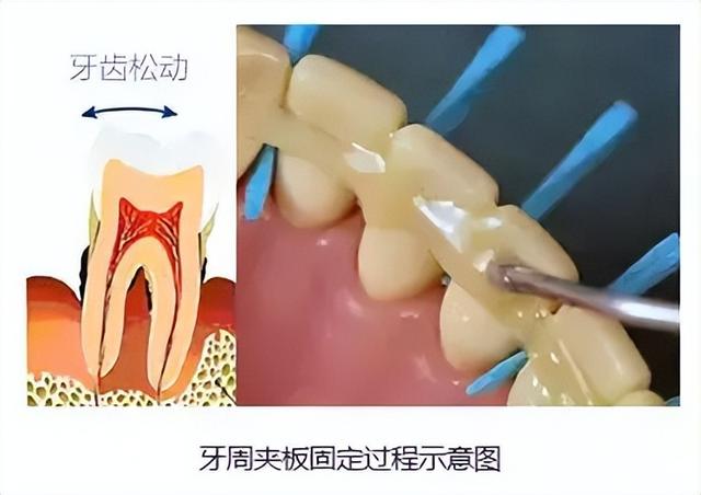 牙齿松动别忽视，一篇教你怎么办