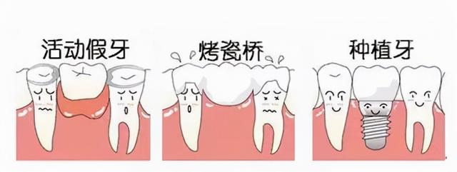 「牙齿那些事儿」No.112丨种植牙大揭秘：听说不太疼，是真的吗？