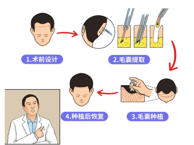 植发必看！大城市植发大概多少钱？植发3000个毛囊多少钱？