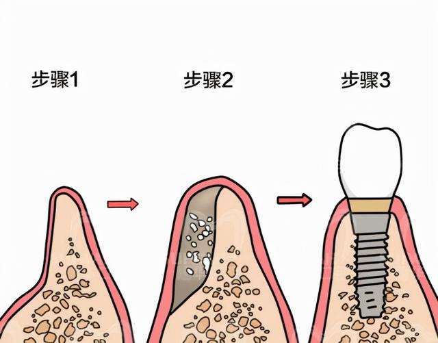 为什么种植牙要加骨粉、骨膜？