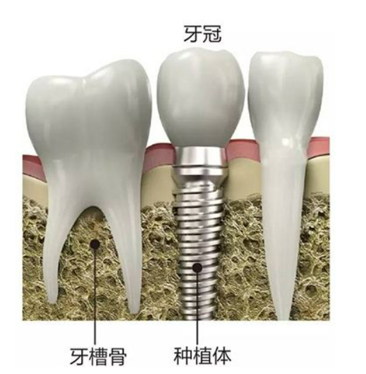 口腔专家告诉你，大热的种植牙到底是不是“智商税”？