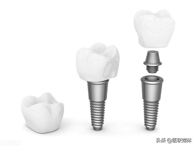 想做种植牙，又怕走弯路？看看牙科医生的“种牙攻略”