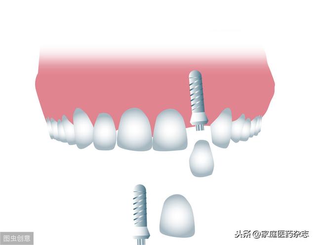 问&答：种植牙松动了怎么办？