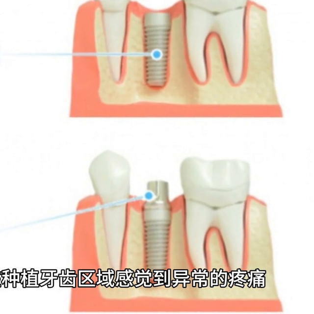 种植牙的保养和维护，你知道吗？