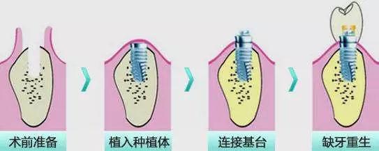 种植牙到底疼不疼？种植牙手术需要经历什么过程？资深牙医告诉你