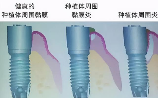 做完种植牙2年，牙齿就摇摇欲坠！医生警告：种植牙也会发炎