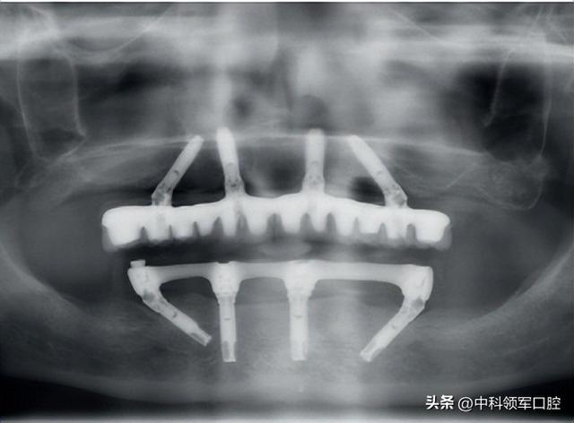 种植牙中的即刻种植、即刻负重是什么意思？