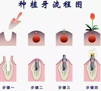 种植牙的简介