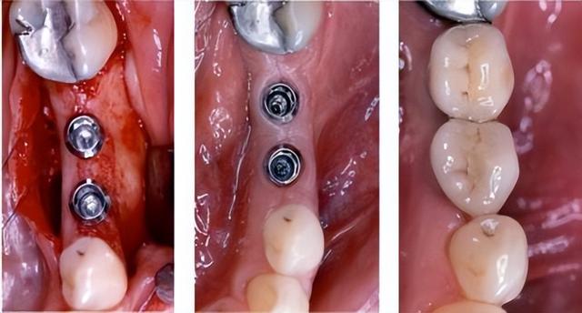 种牙10年，牙槽骨会坏死吗？听听临床医生的回答