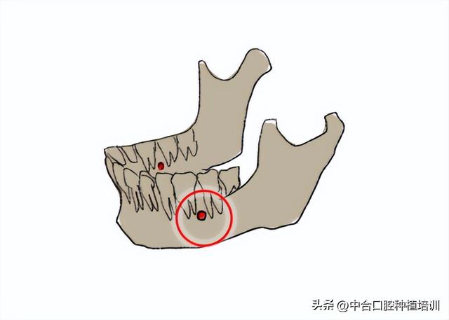 答疑会回顾（1）植骨是否要与种植同期？骨膜在什么情况下需要？