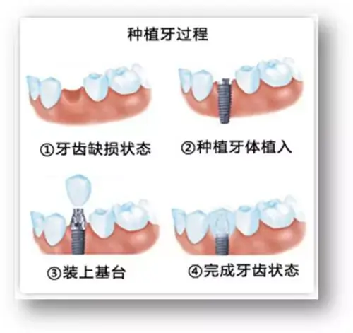 嘴里有颗种植牙是什么样的感觉，和真牙又有什么区别