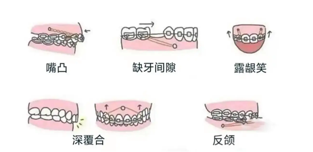 牙齿正畸，你要不要打骨钉？想知道的进