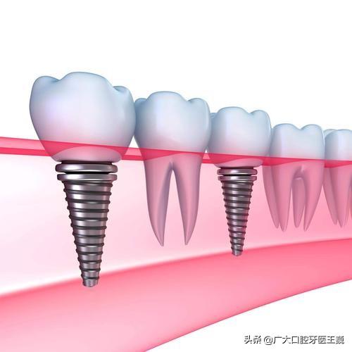 种植牙和烤瓷牙不能牙齿矫正？别慌！看这里