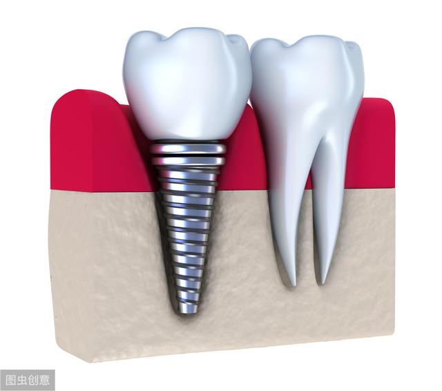种植牙的简介