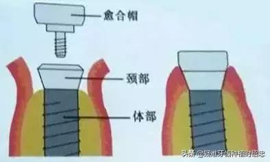 关于种植手术的分类方式有哪些？