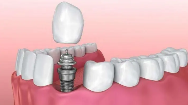 种植牙和烤瓷牙，其实并无差别？专家提醒：并非种植牙不可