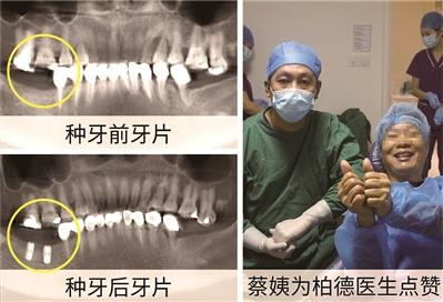 德国生长因子种植牙技术 千人体验千人好评