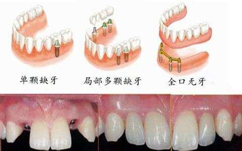 种植牙与义齿的主要区别是什么