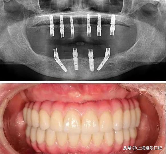 演艺圈明星的“御用牙医”—上海维乐口腔种植大师王建文