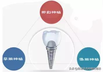 关于种植手术的分类方式有哪些？