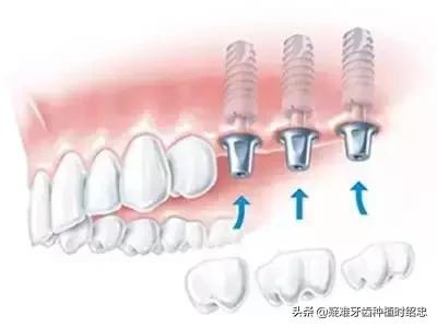 种植牙必须满了十八岁以后才可以做吗？