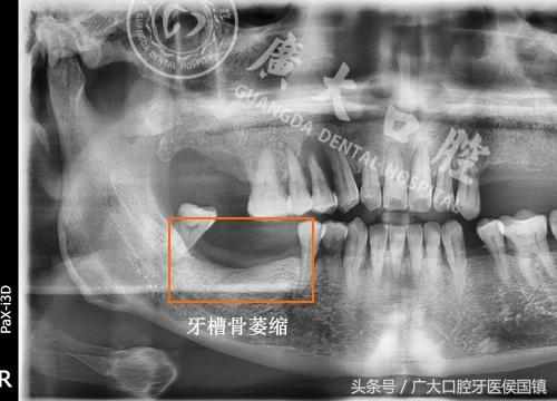 骨量不足种牙难，你要放弃第三副牙齿吗？