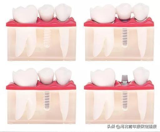 赶快领！种植牙福利补贴来了！种一颗送一颗，保定缺牙人士了解一下