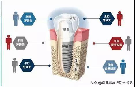 赶快领！种植牙福利补贴来了！种一颗送一颗，保定缺牙人士了解一下