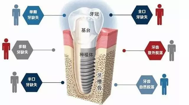 关于佛山种植牙最常见的问题解答（上篇）