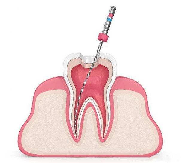 做了根管治疗的牙还疼，牙科医生：警惕这三种原因！