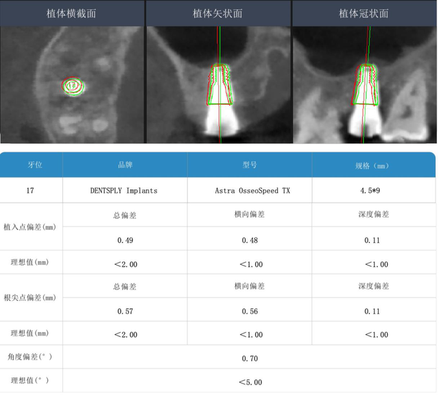 江西省首例！口腔数字医疗——机器人种牙来了