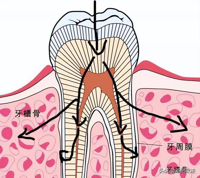 牙没了想补牙，选烤瓷牙还是种植牙？