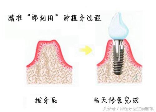 种植牙详细过程是怎么样的？