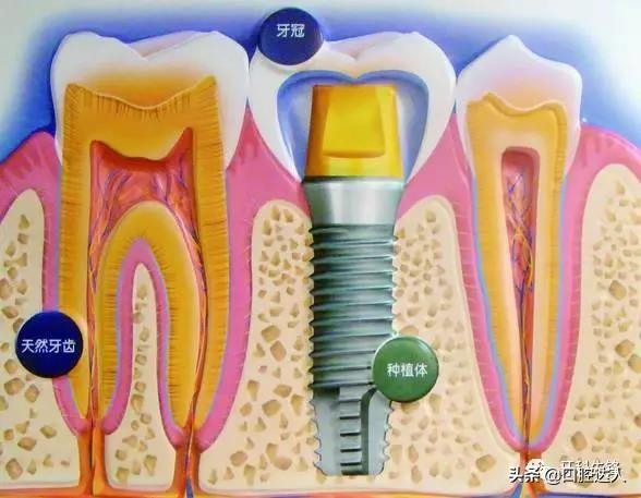 种牙后就能随意咬硬物？种植牙的六大误区你了解吗？