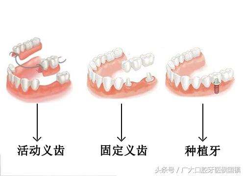 骨量不足种牙难，你要放弃第三副牙齿吗？