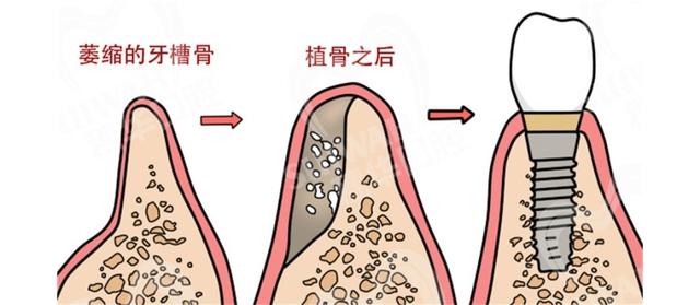 高龄老人能不能种牙？种牙前，还需要注意哪些事情？