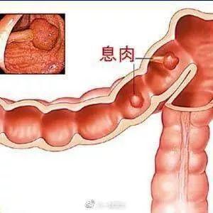 结直肠癌或将成为国内第一大癌,究竟该如何防治？